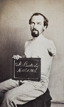 Sgt. Martin Burke, Co K 15 NY Heavy Artillery, Wounded at Petersburg, June 25, 1864.