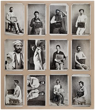 A page from Dr. Reed Bontecou's private wartime surgical album.