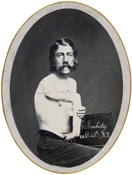 G. Porubsky, Co B. 46th NY Volunteer, Displaying Excision of Humerus.