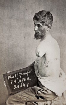 Charles H. Greenfield, 79th. New York, HA, Petersburg, April 2, 1865, Amputation of left arm on field, discharged July 9, 1865.