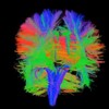 These are axonal nerve fibers in the real brain as determined by the measured anisotropy (directionality) of water molecules inside them. 3T 30 channel GRAPPA DTI scan protocol, deterministic tractogr