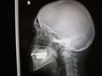 X-ray of skull
