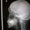 X-ray of skull