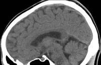 Ct+scan+brain+damage