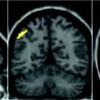 dark brain with yellow patch at supramarginal gyrus neuroimaging scan 