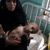 Bassam Mohammed Hassan, who suffers from severe malnutrition and cerebral palsy, at a hospital in Sana, Yemen.