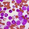 Peripheral blood smear revealing the histopathologic features indicative of a blast crisis in the case of chronic myelogenous leukemia