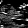 nyu ultrasound of Mary Harris's baby
