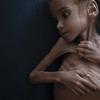 Amal Hussain, 7, is wasting away from hunger. The Saudi-led war in Yemen has pushed millions to the brink of starvation.