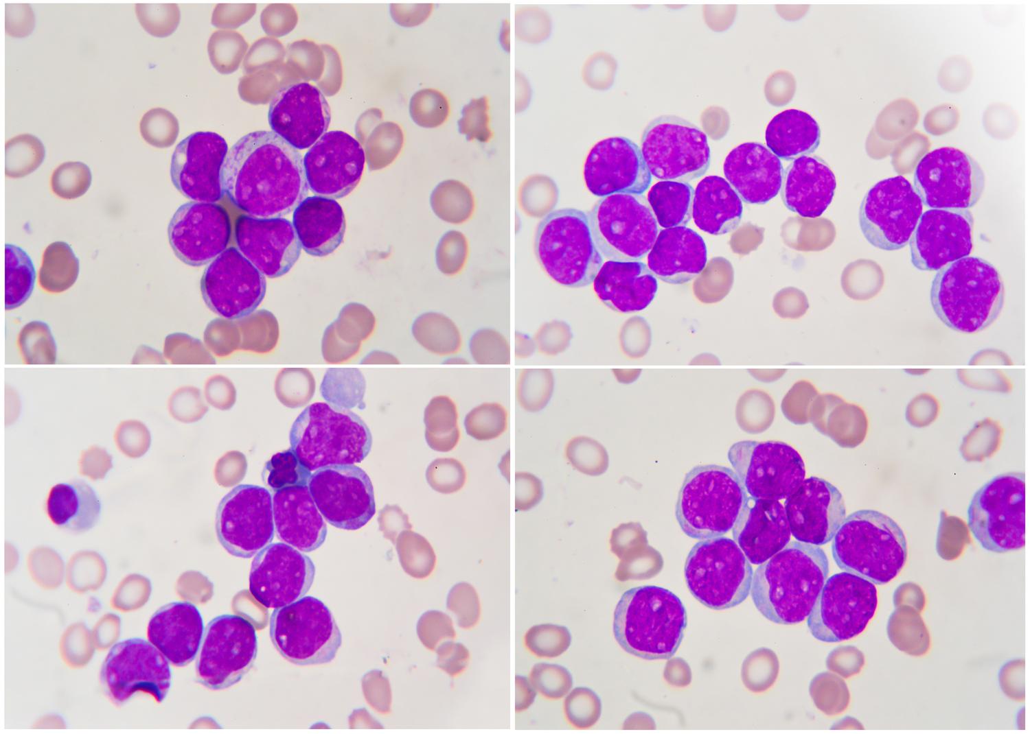Can You Cure Cancer Without Killing It? | The Leonard Lopate Show | WNYC