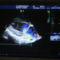 Cardiac Echography