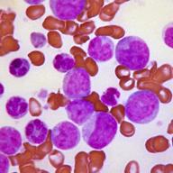 Peripheral blood smear revealing the histopathologic features indicative of a blast crisis in the case of chronic myelogenous leukemia