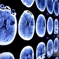Radioactive waste that has seeped into swampland, canals, and drinking water in a small south Florida town, has caused a cluster of brain tumors and cancer among children.