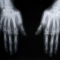 X-ray of human hands