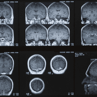 MRI of the brain