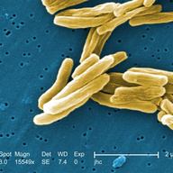 tuberculosis, tb