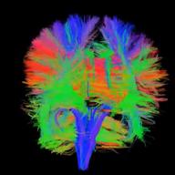 These are axonal nerve fibers in the real brain as determined by the measured anisotropy (directionality) of water molecules inside them. 3T 30 channel GRAPPA DTI scan protocol, deterministic tractogr