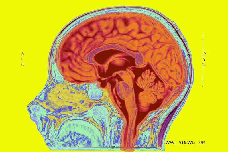 Mri T2 Of A Normal Brain Mid Sagittal View.