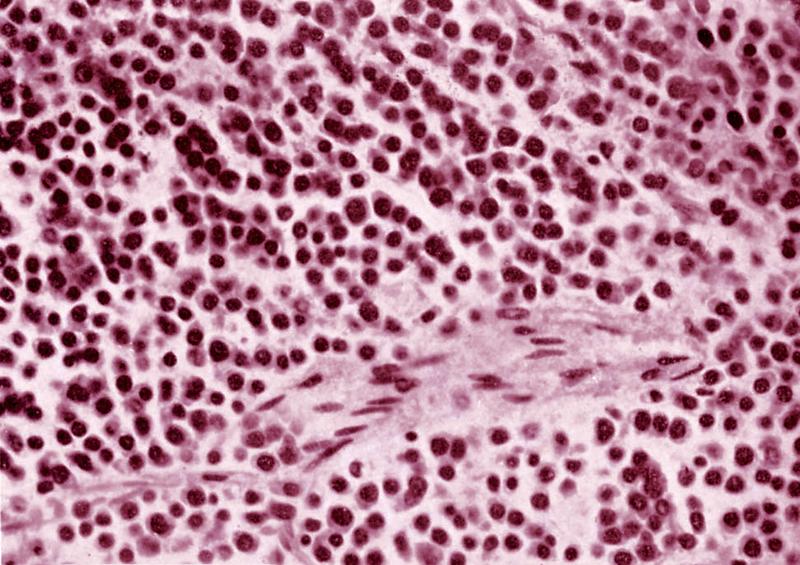 Multiple Myeloma. Section View Of The Bone Marrow.